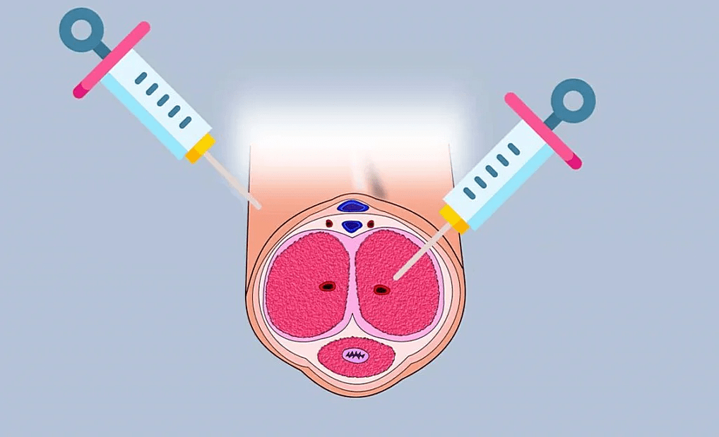Hyaluronic acid injection site