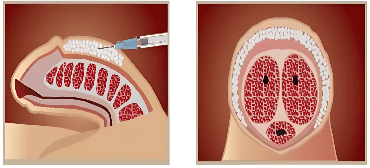 filler injection area