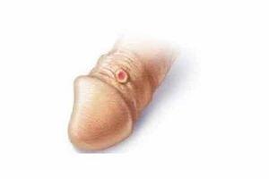 Contraindications for soda penis enlargement