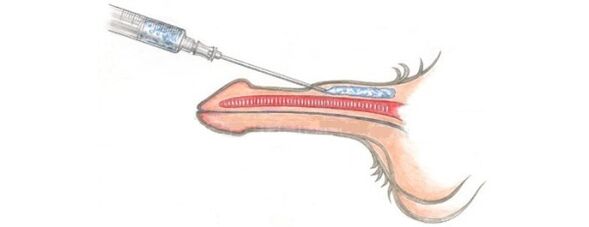 Fat fillers, which allow you to increase the size of your penis