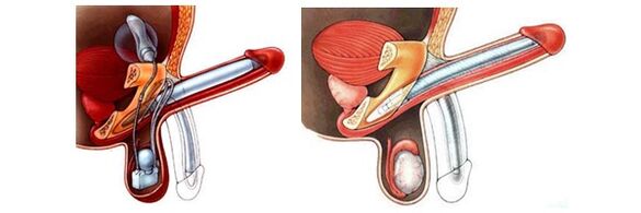 Penile prosthesis with inflatable prosthesis (left) and plastic (right)