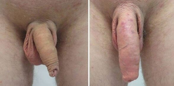 penis before and after hanging